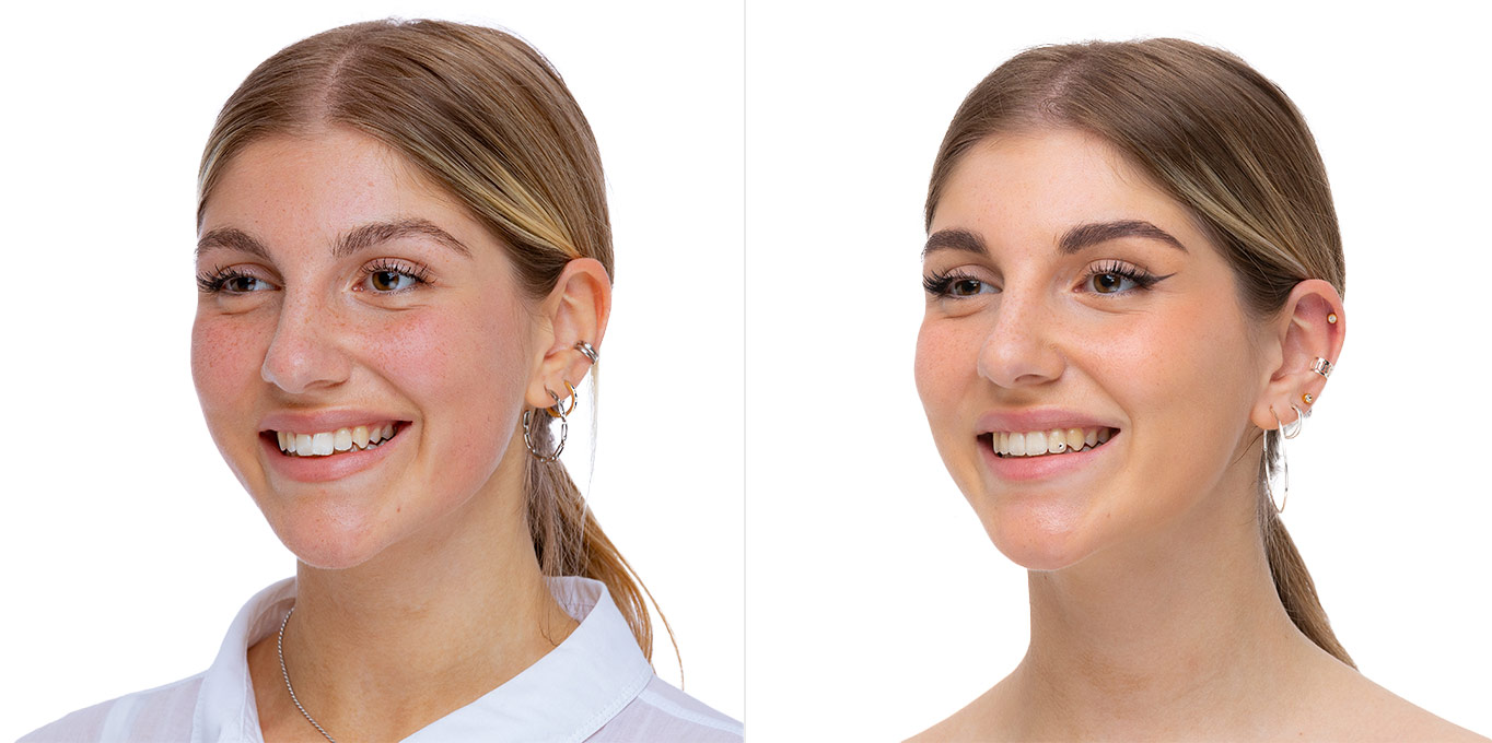 Dr. Töpfer Erwachsene Frau Vorher Nachher Bild Privatpraxis Wiesbaden