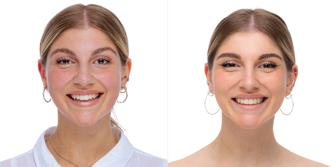 Dr. Töpfer Erwachsene Frau Vorher Nachher Bild Privatpraxis Wiesbaden