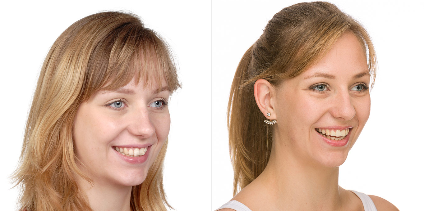 Dr. Töpfer Erwachsene Frau Vorher Nachher Bild Privatpraxis Wiesbaden