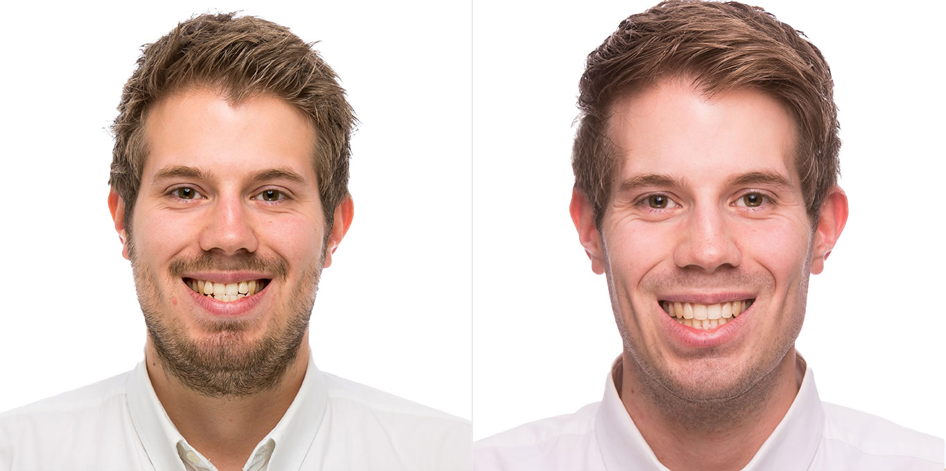 Dr. Töpfer Erwachsener Mann Vorher Nachher Bild Privatpraxis Wiesbaden