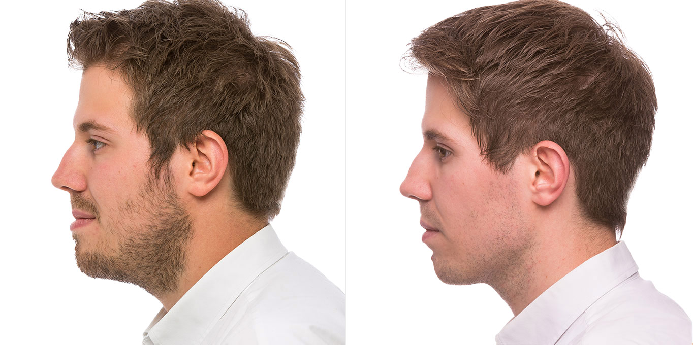 Dr. Töpfer Erwachsener Mann Vorher Nachher Bild Privatpraxis Wiesbaden