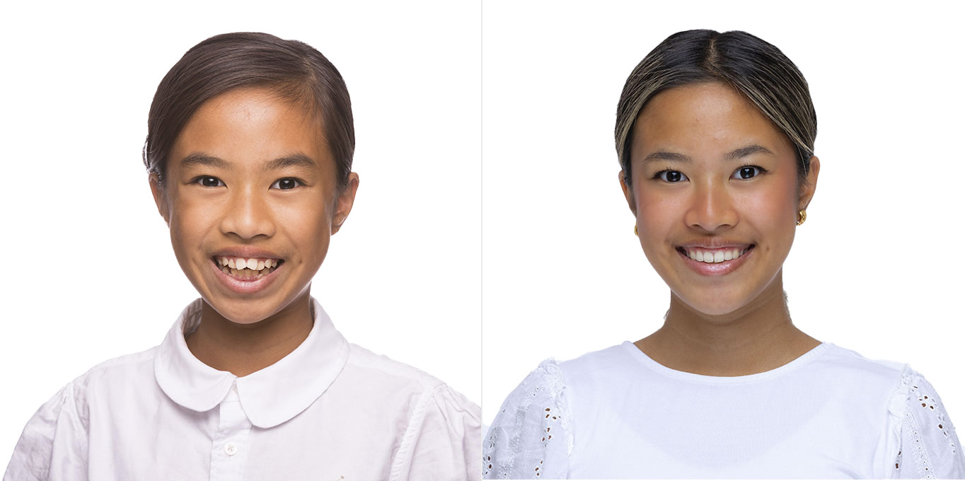 Dr. Töpfer Kind Vorher Nachher Bild Privatpraxis Wiesbaden