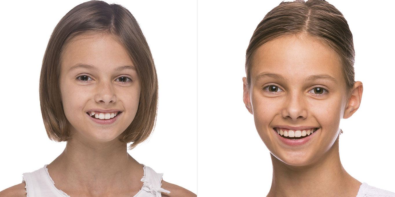 Dr. Töpfer Kind Vorher Nachher Bild Privatpraxis Wiesbaden