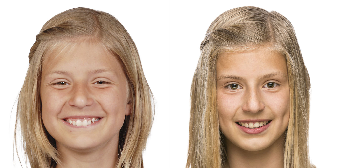 Dr. Töpfer Kind Vorher Nachher Bild Privatpraxis Wiesbaden