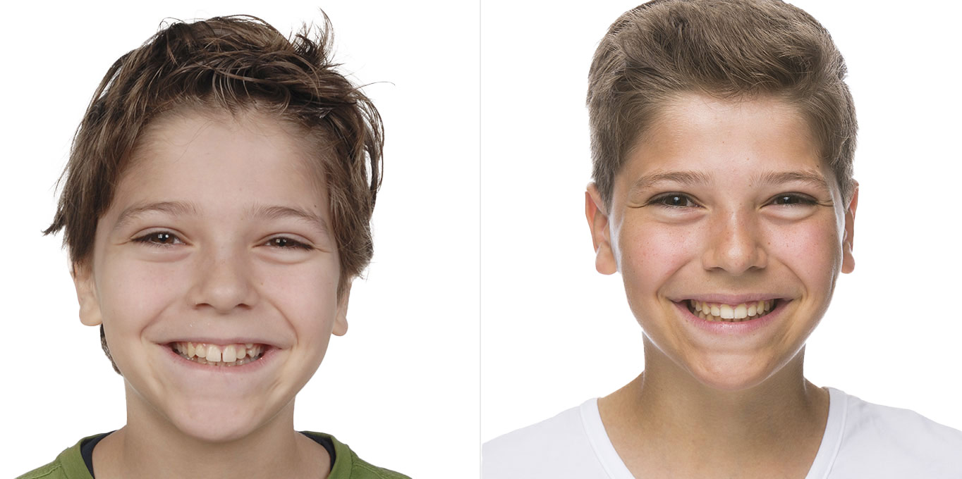 Dr. Töpfer Kind Vorher Nachher Bild Privatpraxis Wiesbaden