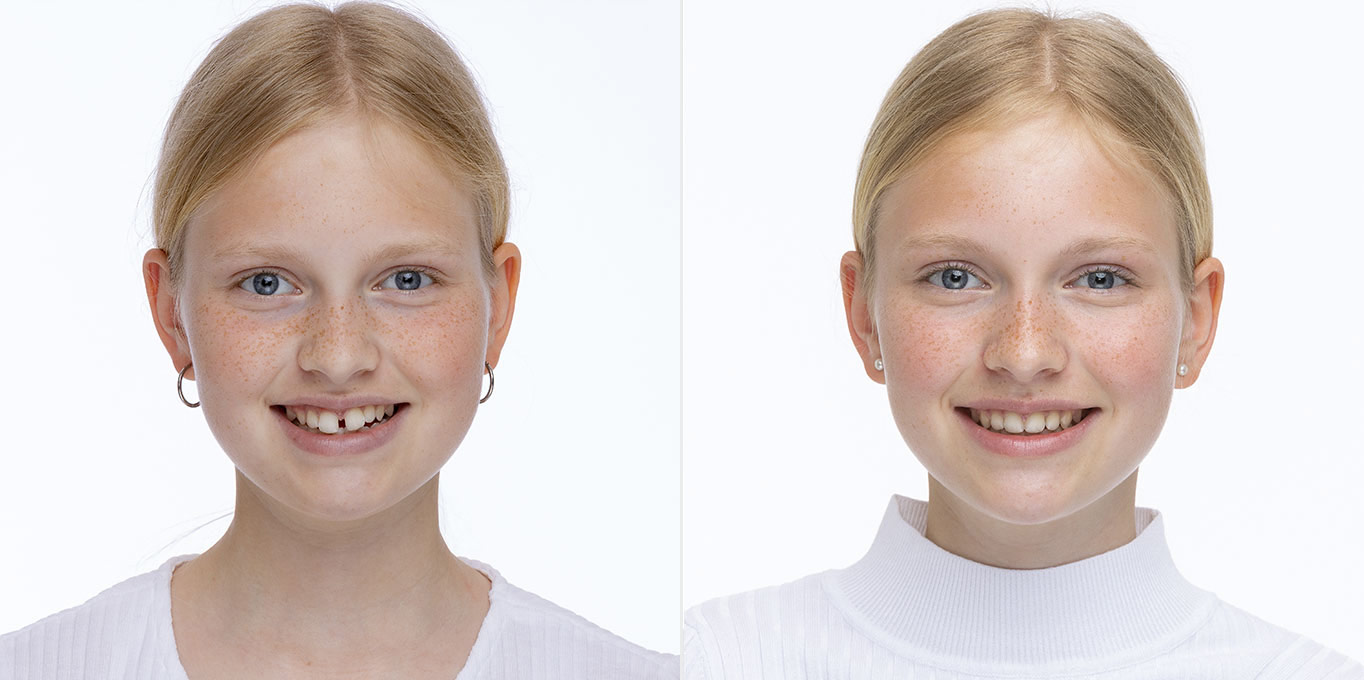 Dr. Töpfer Kind Vorher Nachher Bild Privatpraxis Wiesbaden