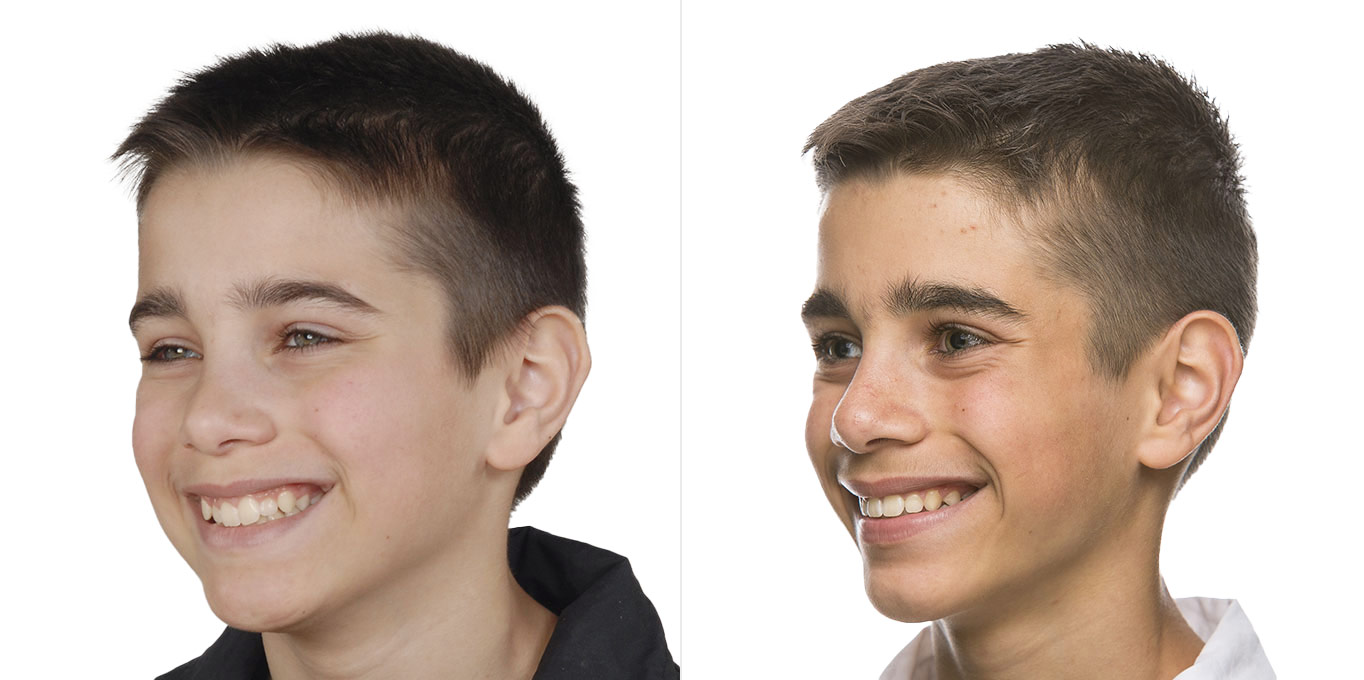 Dr. Töpfer Kind Vorher Nachher Bild Privatpraxis Wiesbaden